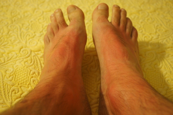Essential Oils for Sunburn
